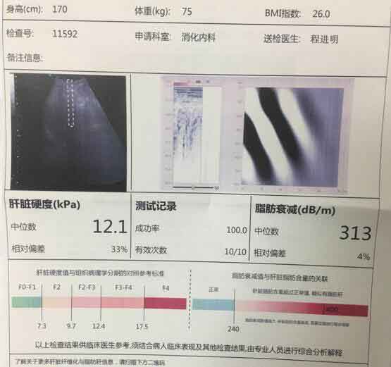 郑州哪儿治疗肝硬化专业?郑州治疗好的肝硬化医院