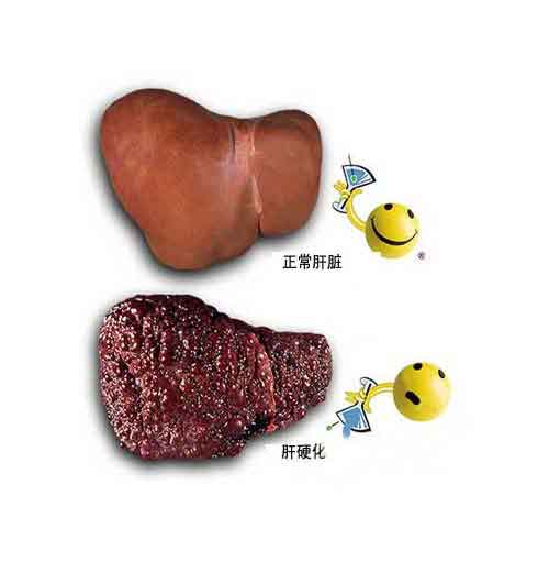 郑州哪儿治疗肝硬化专业?郑州治疗好的肝硬化医院