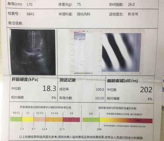 郑州哪儿治疗肝硬化专业?郑州治疗好的肝硬化医院
