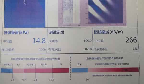 河南哪个肝病医院治疗肝硬化较好