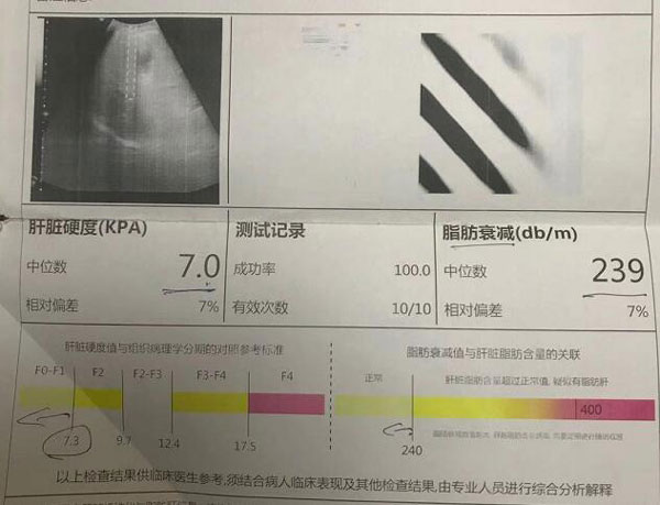 郑州肝硬化看的好的医院哪家好